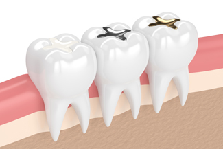 gingivitis-teeth-mackay