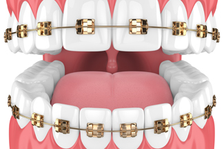 invisalign-teeth-mackay