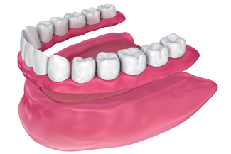 dental-implants-mackay